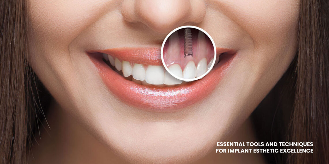 Implant Esthetic Excellence